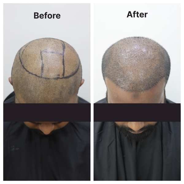 Eyebrow Transplant result KOQ10